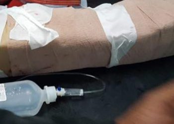 herido bala robando foto pierna