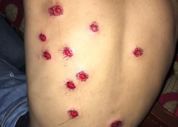 joven herido perdigones