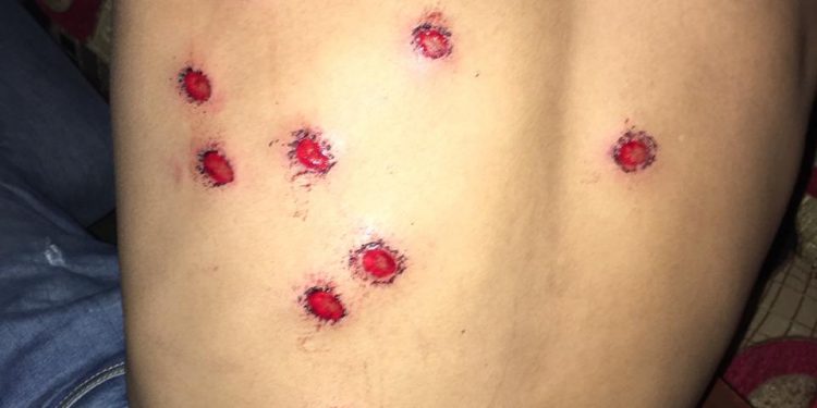 joven herido perdigones