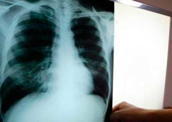 República Dominicana registró 3,210 casos de tuberculosis en el año 2021