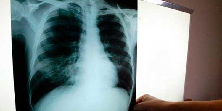 República Dominicana registró 3,210 casos de tuberculosis en el año 2021