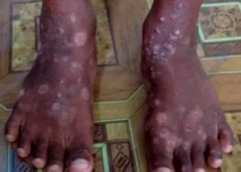 Autoridades de Haití advierte sobre una rara y «altamente contagiosa» enfermedad de la piel
