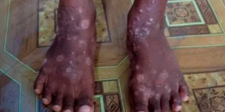 Autoridades de Haití advierte sobre una rara y «altamente contagiosa» enfermedad de la piel