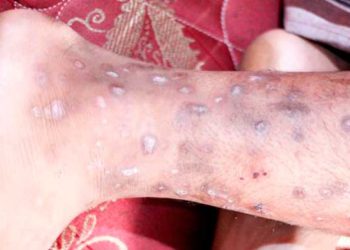Conozca las orientaciones de Salud Pública sobre infección contagiosa detectada en Haití