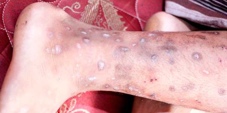 Conozca las orientaciones de Salud Pública sobre infección contagiosa detectada en Haití