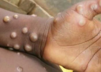 Salud Publica emite alerta preventiva por la viruela del mono para RD
