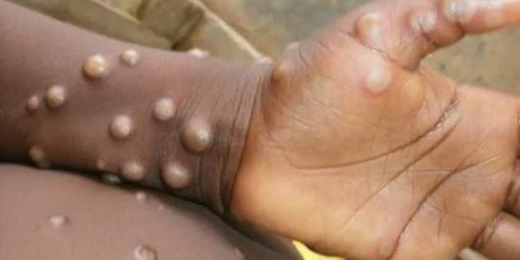 Salud Publica emite alerta preventiva por la viruela del mono para RD