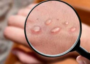 OMS declara emergencia internacional por el brote de viruela del mono