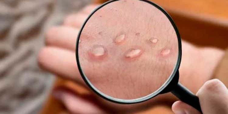 OMS declara emergencia internacional por el brote de viruela del mono