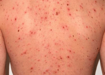 Solicitan incentivar vacunación ante alerta de sarampión en el país