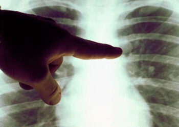 Estudio señala que la contaminación del aire promueve el cáncer de pulmón en no fumadores