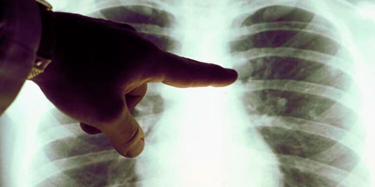 Estudio señala que la contaminación del aire promueve el cáncer de pulmón en no fumadores